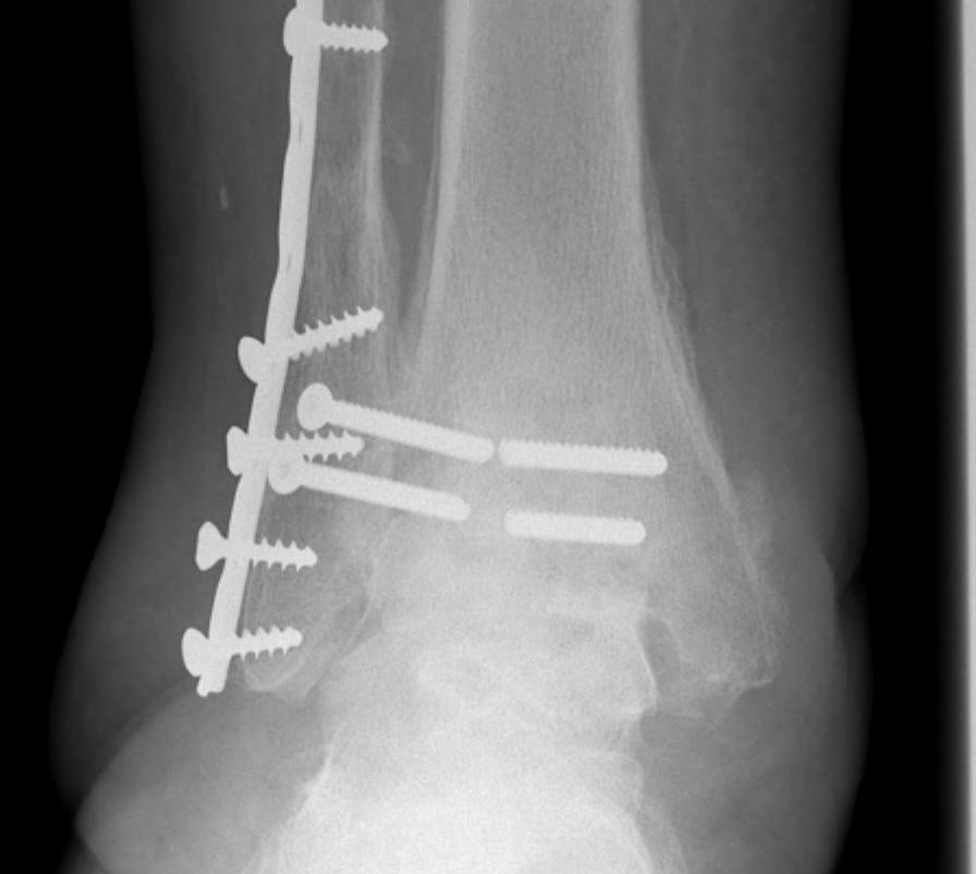 Ankle Broken Diastasis Screws